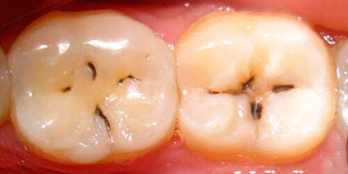 Темные пятна на зубах: причины появления и способы избавиться