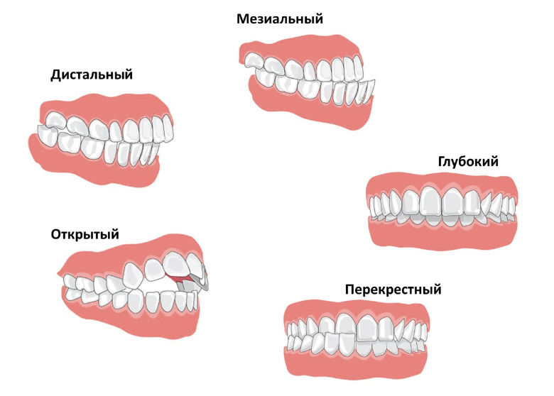 Правильный прикус у человека схема