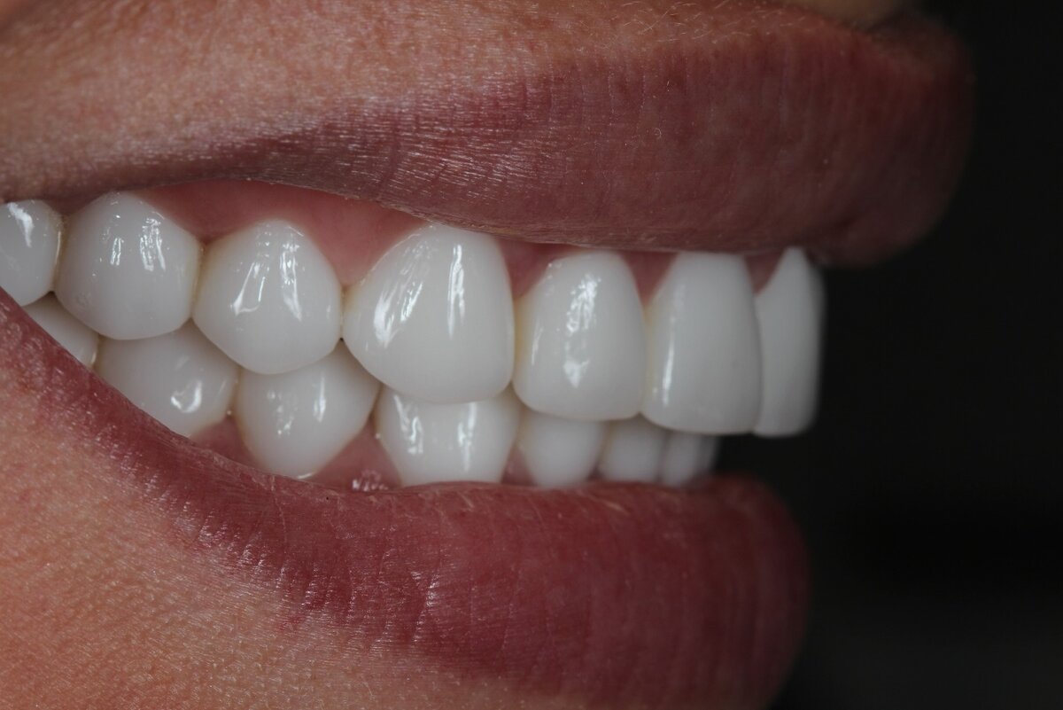 Фото взято из сети Интернет. К сожалению, мои зубы пока выглядят не так. Как будет конечный результат лечения, я поделюсь с Вами. 