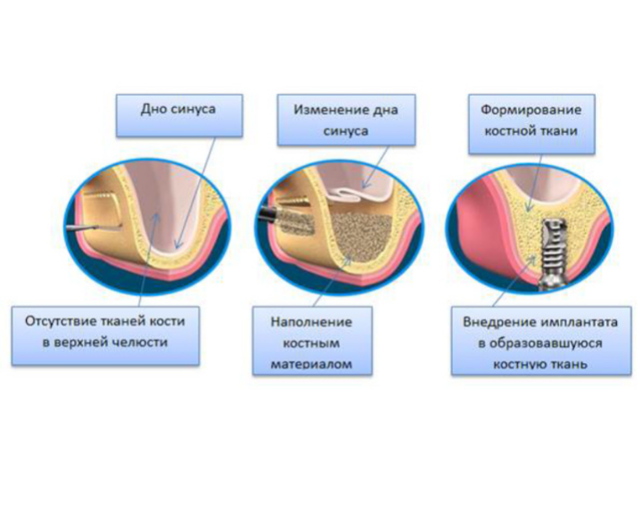 Синус лифтинг верхней челюсти
