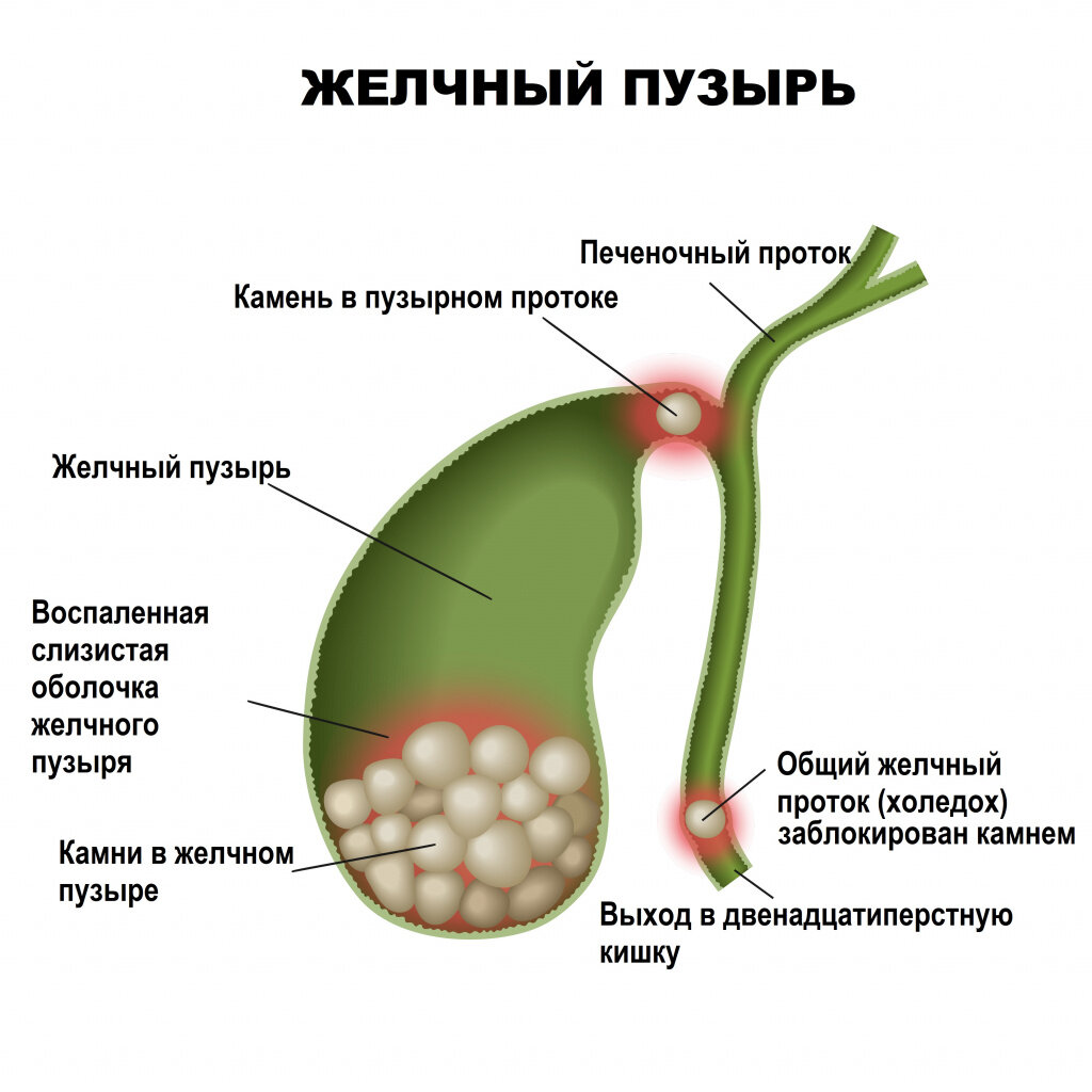 Лечение желчнокаменной болезни