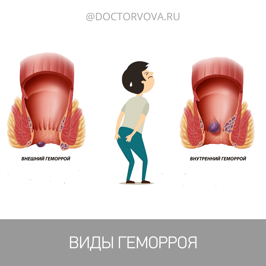 Проблемы со стулом после анального секса (Множество фото) -  fotodekormebel.ru