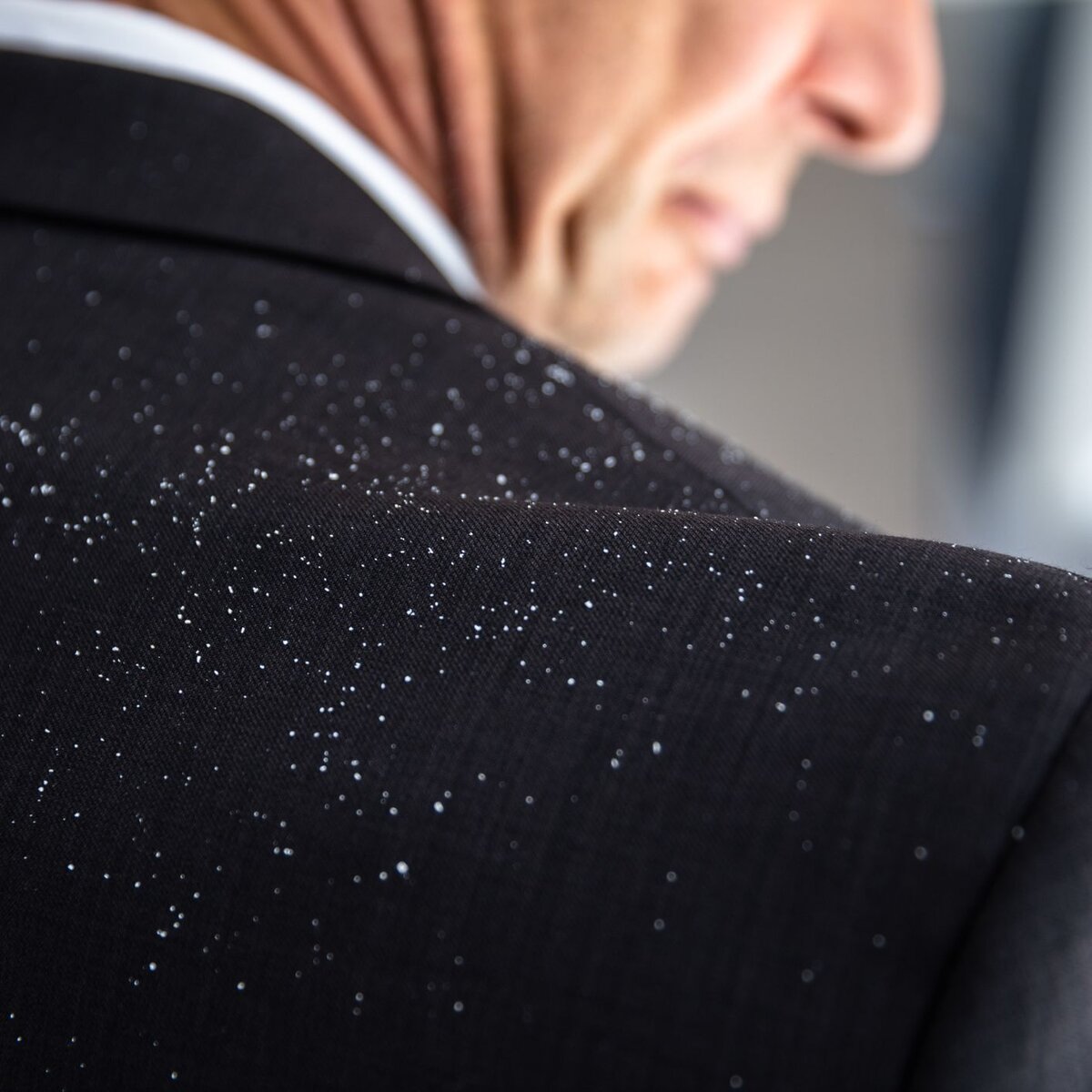 Как бороться с перхотью?