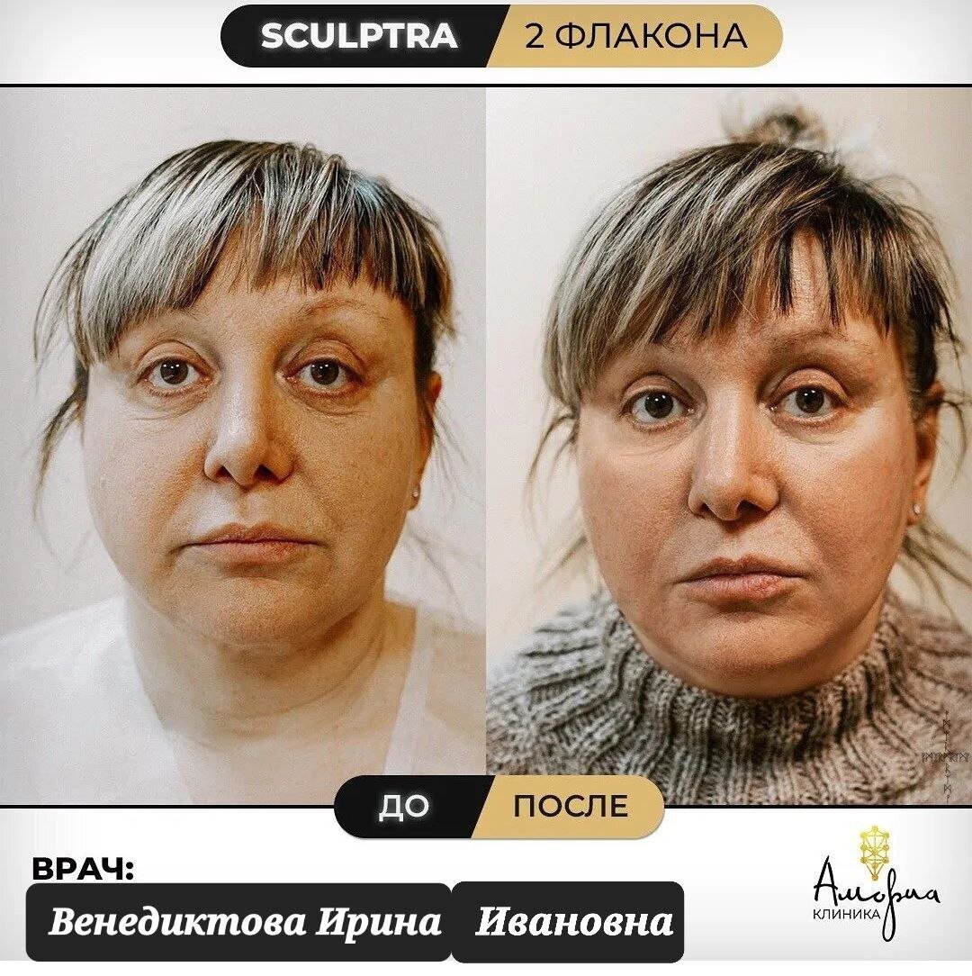  фото ДО и ПОСЛЕ процедуры Sculptra