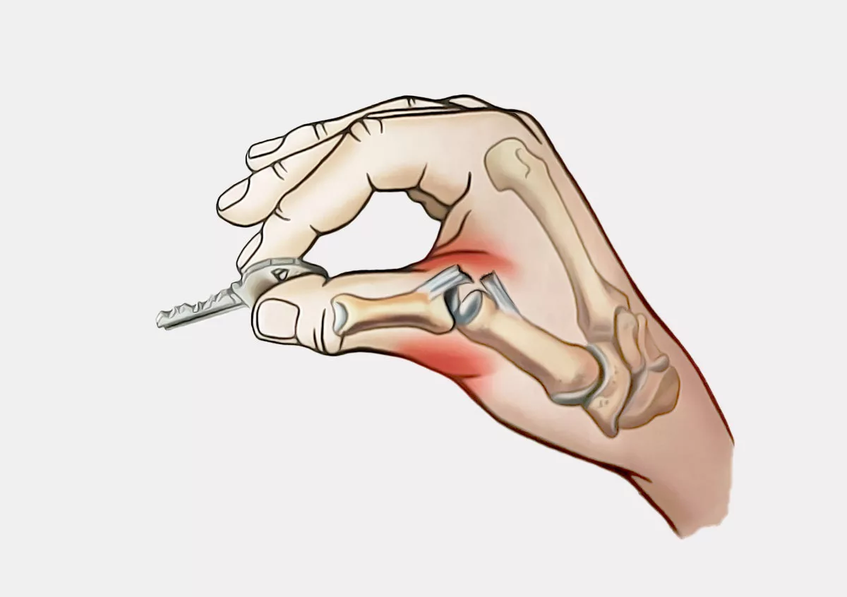 Растяжении связок кисти руки: симптомы, диагностика, лечение в клинике 
