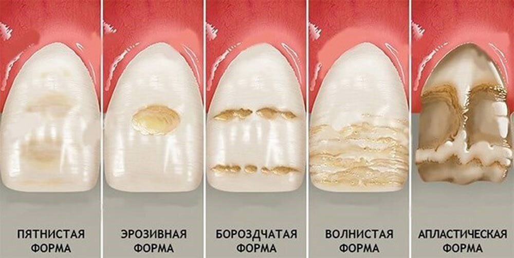 ОТБЕЛИВАНИЕ ПРИ ФЛЮОРОЗЕ