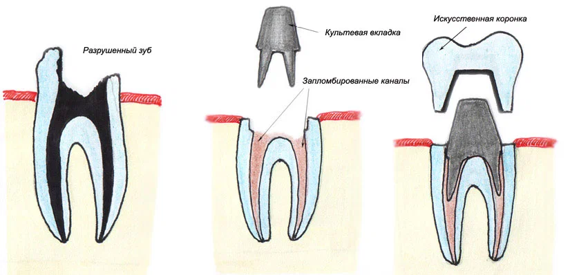 Почему открывают зуб. Культевая вкладка и коронка схема. Культовая вкладка и коронка. Культевая вкладка и коронка. Штифтовая культевая вкладка.