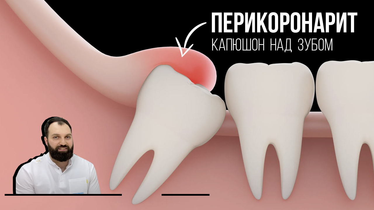 Перикоронарит – воспаление десны над зубом мудрости