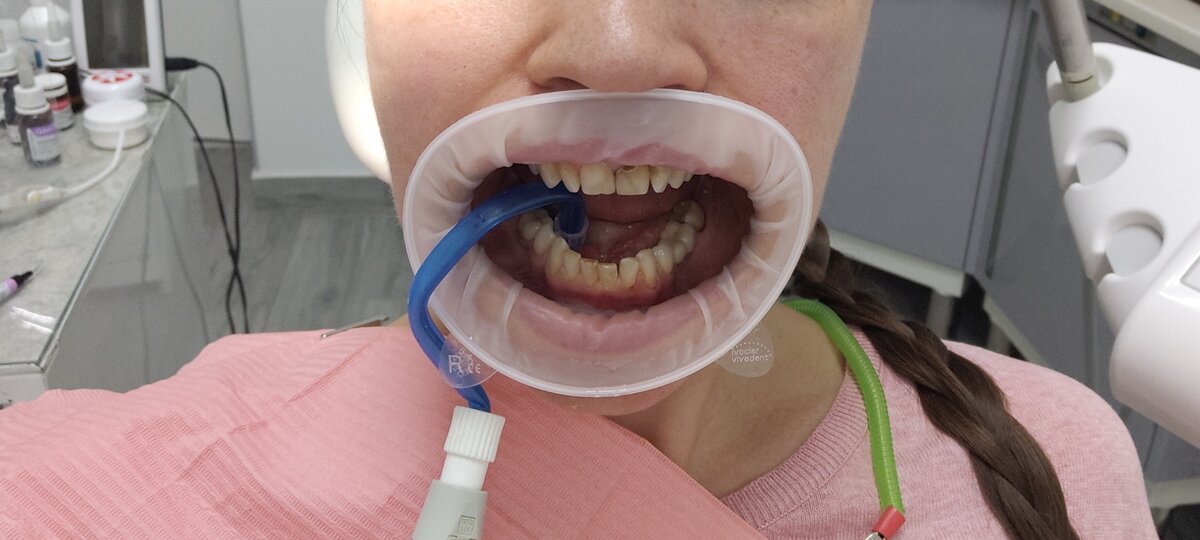 авторские кариозные кривульки