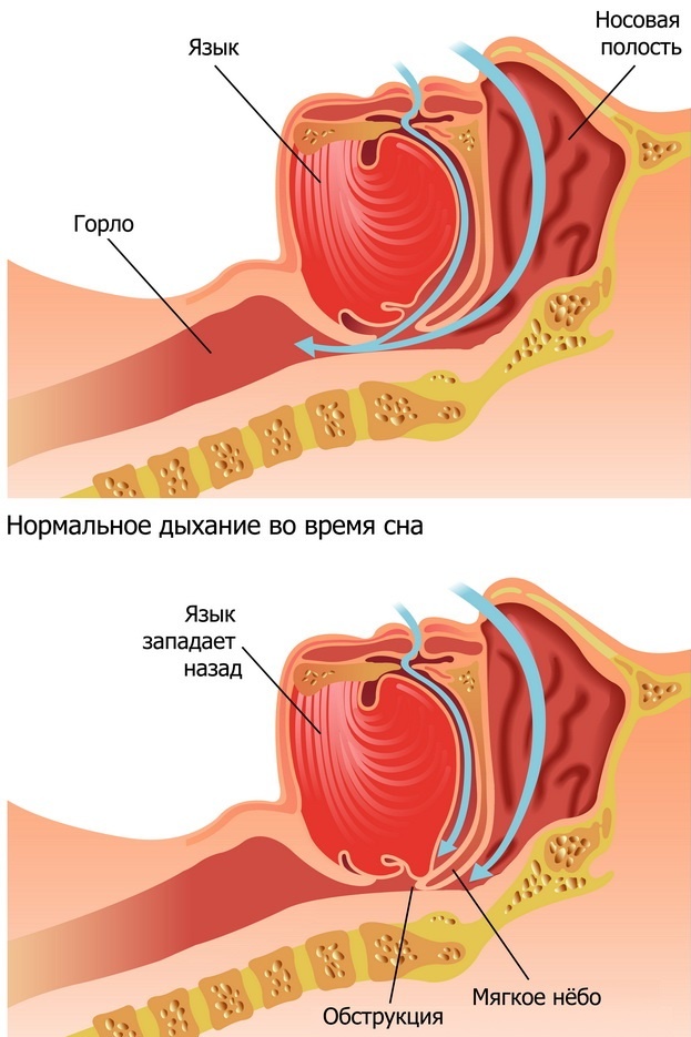 Обструктивное апное сна