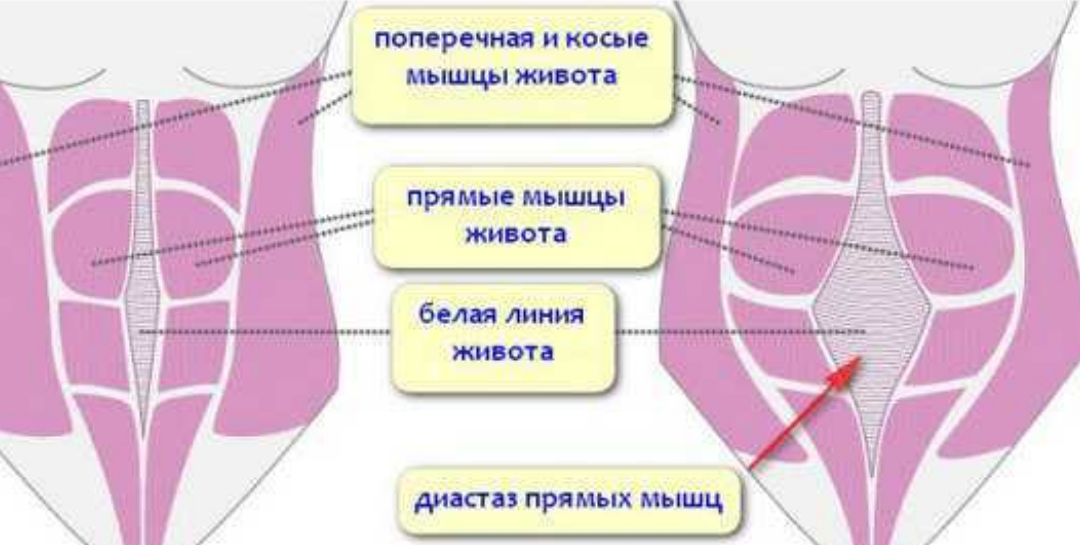 Разница в положении мышц в норме и при диастазе. Белая линия - сухожильная пластина, которая растянулась, но не смогла вернуться в исходное положение. Не хватило эластичности. Источник изображения: Яндекс. Картинки