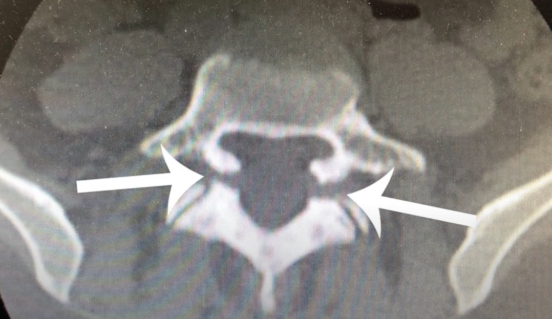 Незаращение дуги