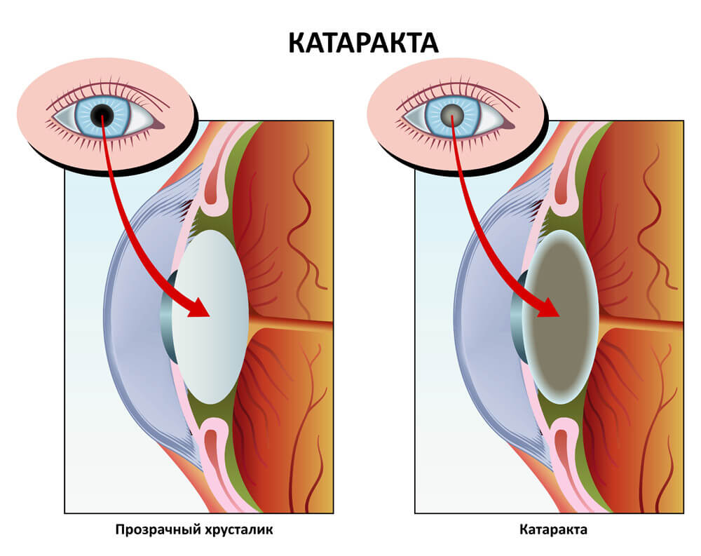 Алоэ при катаракте