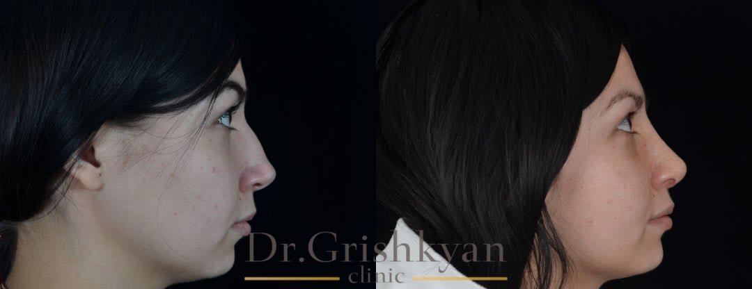 Повторная ринопластика фото до и после. Фото с сайта Д.Р. Гришкяна. Имеются противопоказания, требуется консультация специалиста