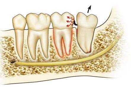Вывихи и переломы зубов