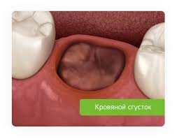 После удаления, в идеале, лунка удаленного зуба должна заполниться кровяным сгустком. 