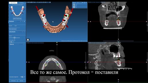 Обсуждение вашей имплантации выглядит иначе? Мы за предсказуемый результат. Презентация плана лечения в цифровом протоколе.