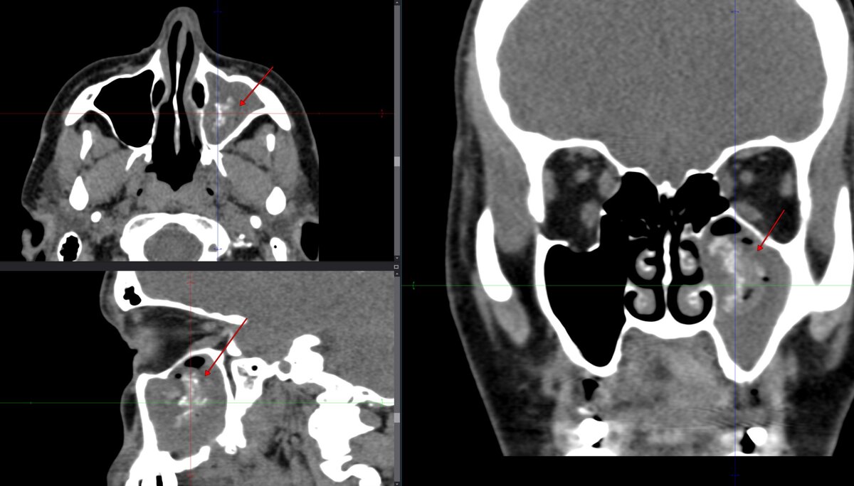 Рис. 1. Патологический субстрат (красная стрелка) неоднородной повышенной плотности