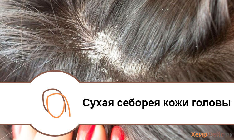 Сухая себорея: диагностика, симптомы, причины, методы лечения