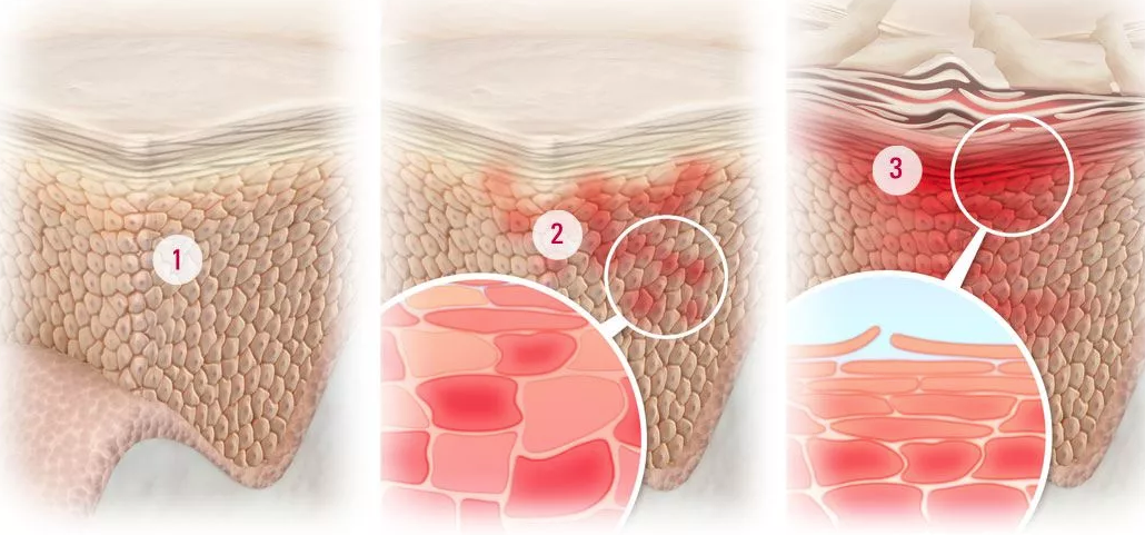 В кожу в результате. Воспаление эпидермиса кожи. Атрофия эпидермиса и дермы. Обезвоживание клеток кожи.