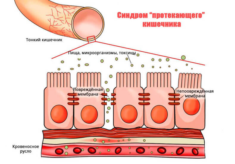 Синдром повышенной. Синдром повышенной кишечной проницаемости. Синдром дырявого кишечника. Синдром протекающего кишечника. Синдром проницаемости кишечника