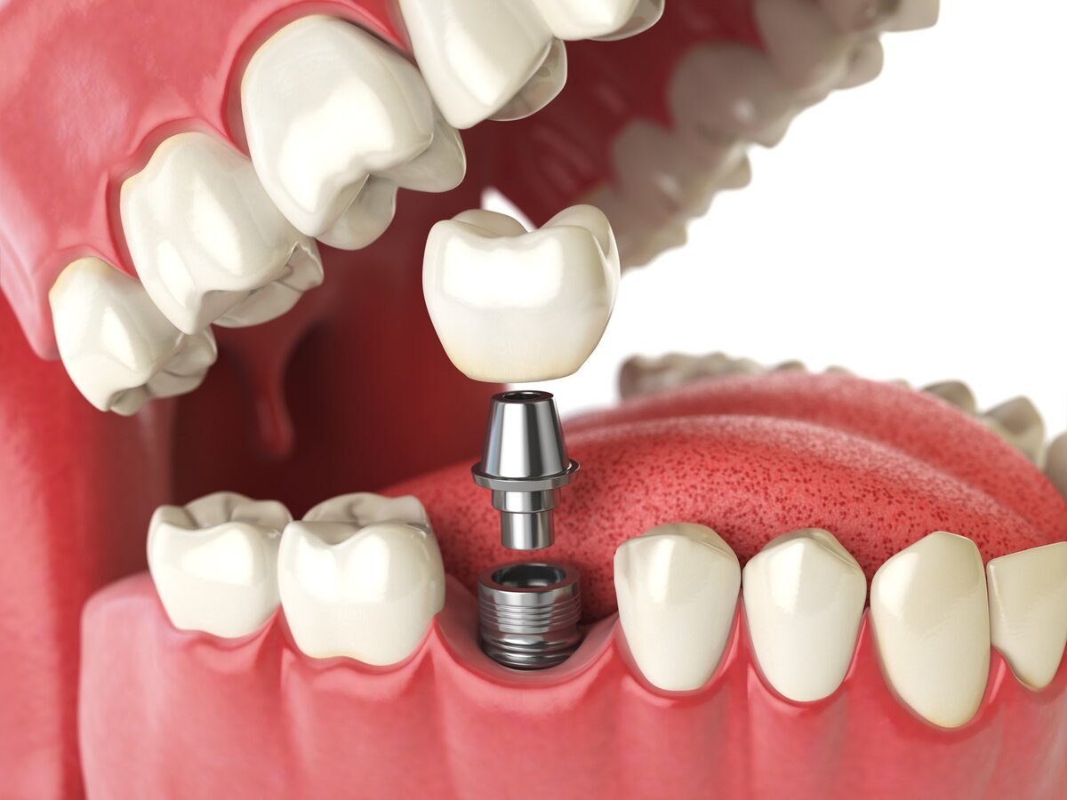 Современная медицина знает только два способа восстановления утерянных или разрушенных  зубов: мостовидные протезы или импланты.