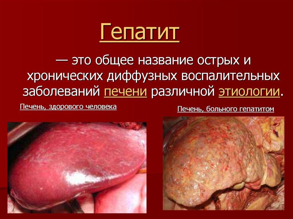 📌Гепатит С – это инфекционное заболевание, поражающее печень и являющееся одним из наиболее распространенных и опасных видов гепатита. 

📍Гепатит С, симптомы которого в течение длительного времени могут вообще не проявляться, зачастую протекает с поздним его диагностированием. Многие люди могут годами жить с вирусом, не подозревая, что они больны.

📌К сожалению, гепатит C имеет еще одно название – это «ласковый убийца». Это связано с возможностью его бессимптомного развития и течения.⛔ Человек может и не подозревать о своем инфицировании, живя даже 30-40 лет. Выявить вирус можно только при помощи анализов. 

📍В это же время, вирус постепенно развивается в организме, провоцирует развитие хронического заболевания печени, медленно ее уничтожая. Печень – это главная мишень вирусов гепатита, поэтому она нуждается в поддержке при данном заболевании.

❗️Важно понимать, что ни один человек не застрахован на все 100% от вируса гепатита С, поэтому хотя бы раз в год надо сдавать анализы на наличие HCV для своего же блага.