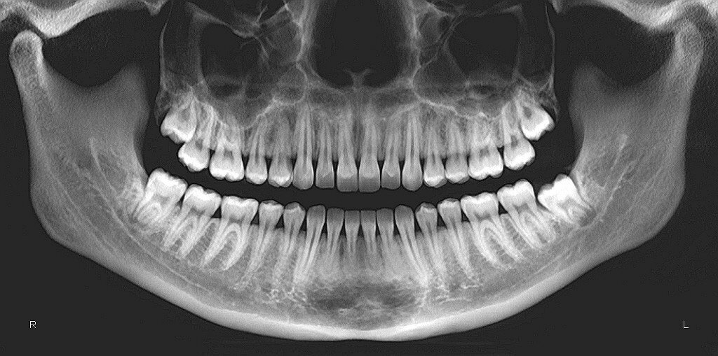 Панорамный снимок челюсти