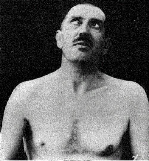 Акинетический мутизм.