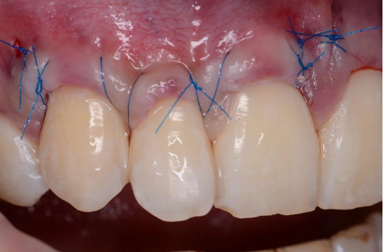 На десне проведена операция - гингивопластика - пластика десны