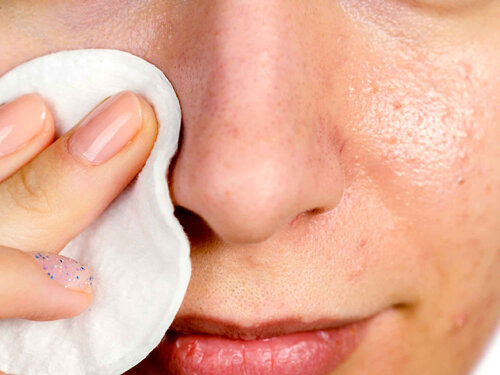 Проблемы жирной кожи.