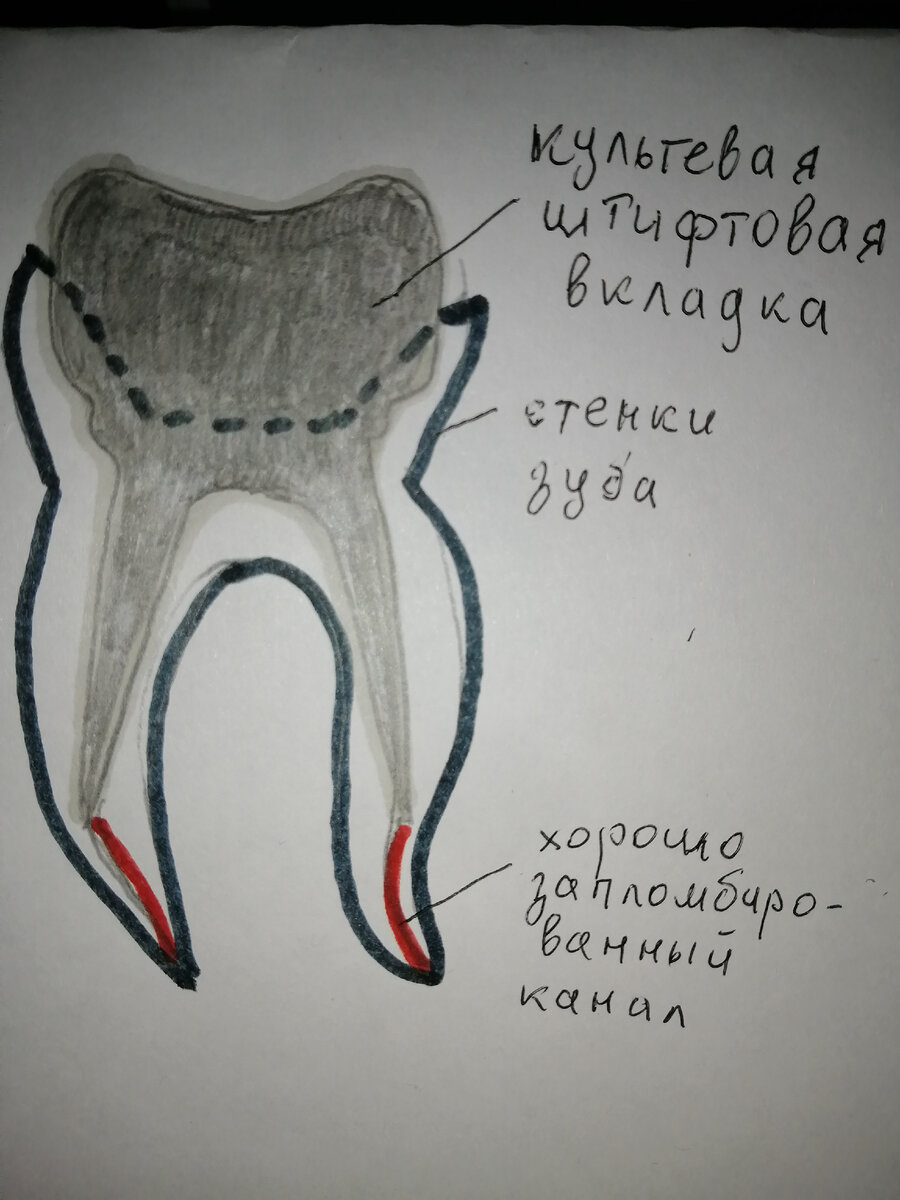 Культевая вкладка, зафиксированная в зуб. (рисунок мой) 