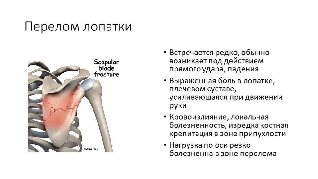 Разрыв лопатки. Классификация повреждений лопатки. Классификация переломов лопатки травматология. Перечислите клинические симптомы при переломе лопатки. Перелом акромиона лопатки симптомы.