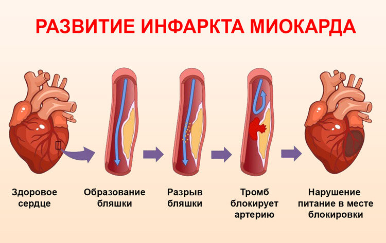 Реабилитация после инфаркта в клинике Альмадея