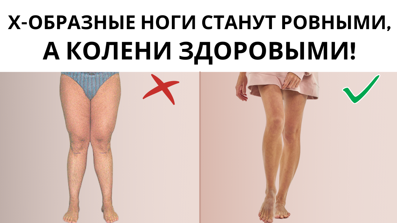 Как исправить х образные. Ложная варусная деформация. Как исправить х образные. Как исправить х образные. Вальгусная деформация икс образные ноги.
