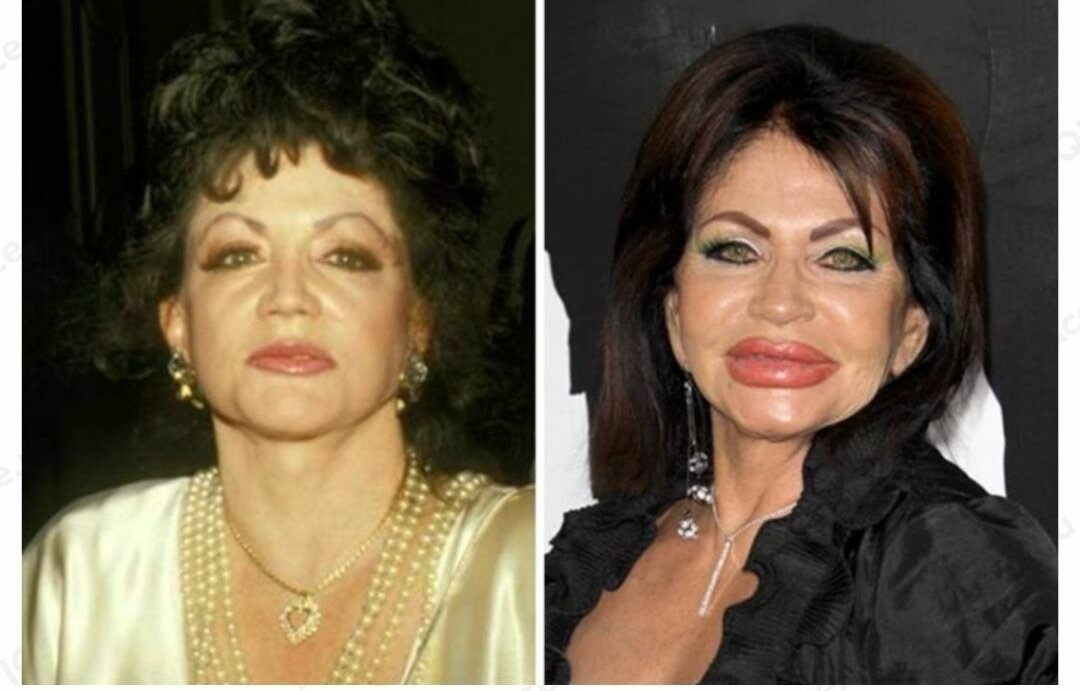 после пластики через 20 лет. бесплатные пластические операции. джослин вильденштейн 2018. бесплатные пластические операции. бесплатные пластические операции.