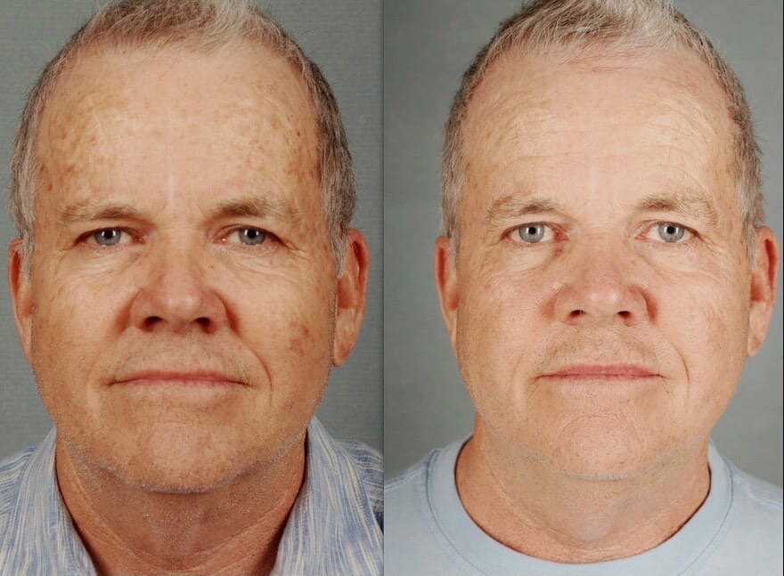 Рубиновый лазер - результат воздействия на пигментированные участки кожи у пациента.