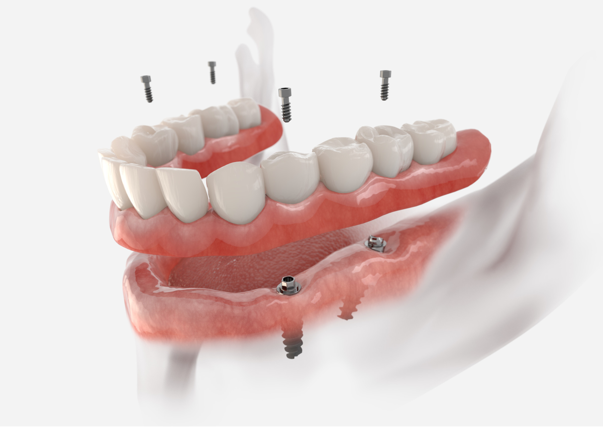Имплантация челюсти на 4 имплантах. Несъемный протез на 4 имплантах Осстем.