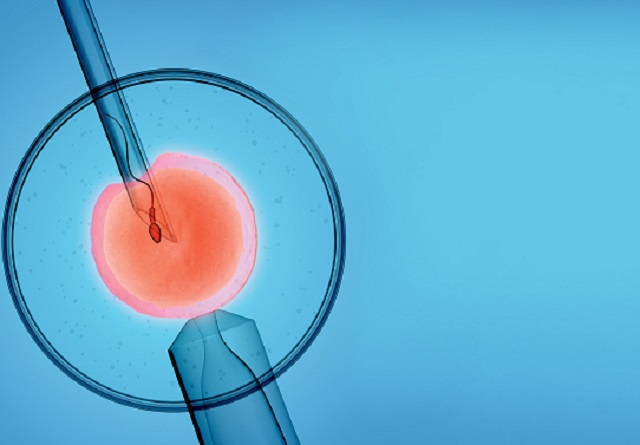 Метод искусственного экстракорпорального оплодотворения (ЭКО).