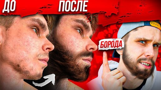 Лучший Способ Отрастить МУЖИЦКУЮ БОРОДУ! МИНОКСИДИЛ (minoxidil)