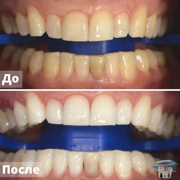 Отбеливание зубов иркутск. Отбеливание Air-Flow до и после. Зубы до и после фотоотбеливания.