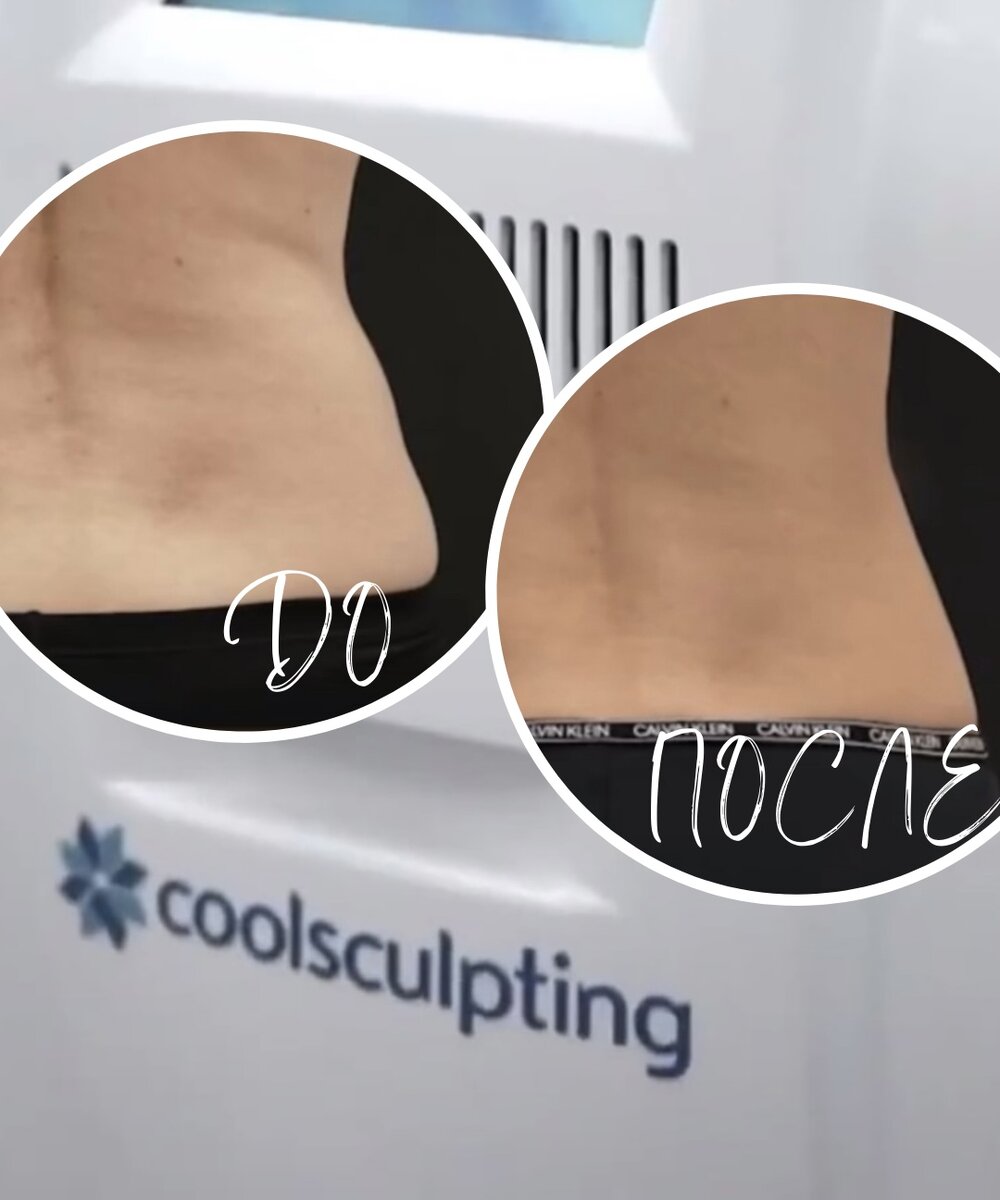 Результат процедуры криолиполиза на аппарате последнего поколения «COOLSCULPTING».