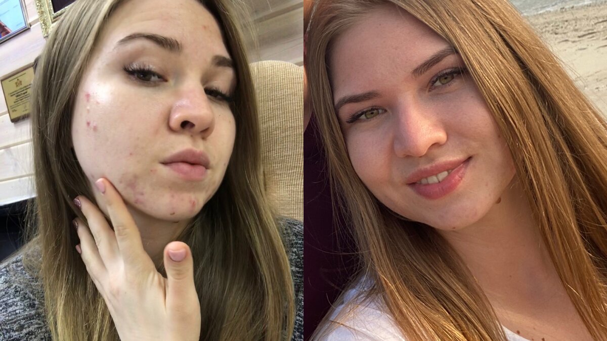 Разница в фото-3 месяца!