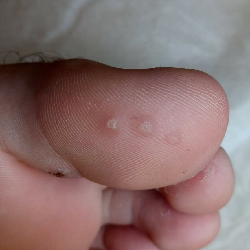 Бородавки на большом пальце