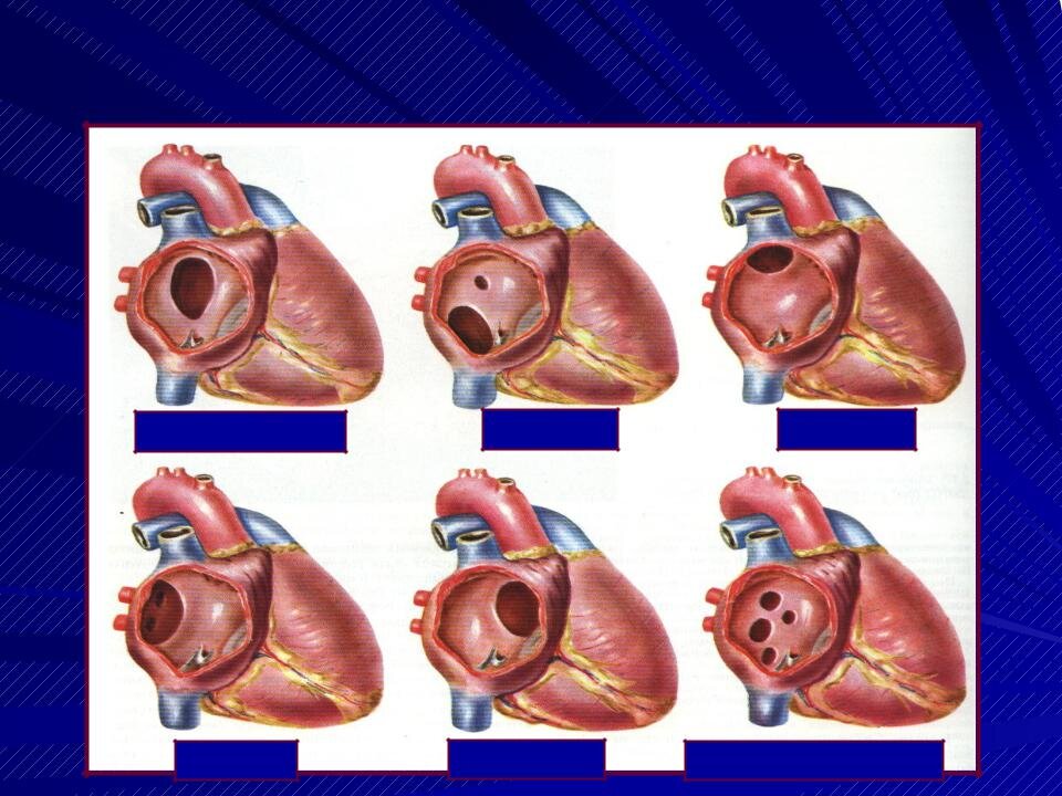 Врожденные пороки сердца схема. Сердца врожденный или приобретенный. Приобретенные клапанные пороки сердца. Сердца врожденный или приобретенный. Приобретенные пороки сердца схема гемодинамики.