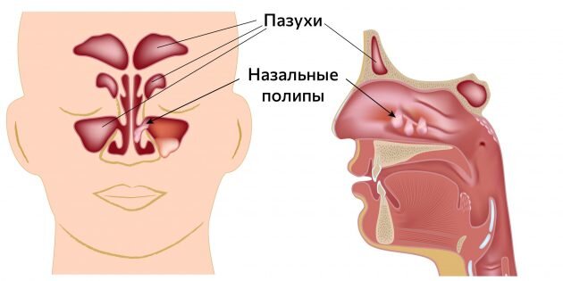 Постоянный насморк у ребенка - что делать? Консультация ЛОР врача