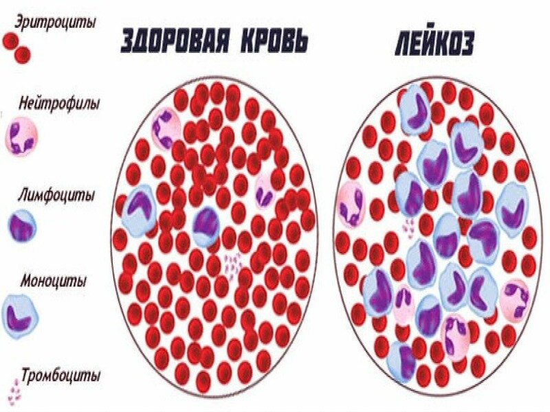 Рак крови картинки