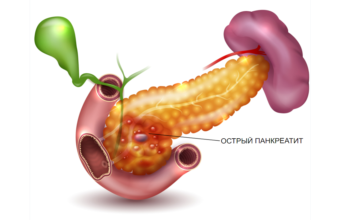 Банан поджелудочная. Анатомия селезенки и поджелудочной железы. Поджелудочная железа желчный пузырь анатомия. Жёлчный пузырь и селезенка одно. Острый панкреатит поджелудочной железы.