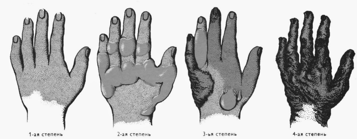 Химические травмы картинки