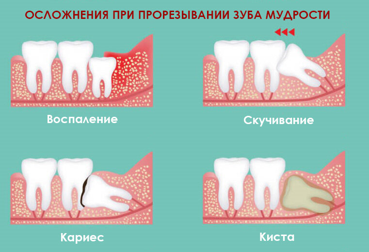 Острая зубная боль: что делать?